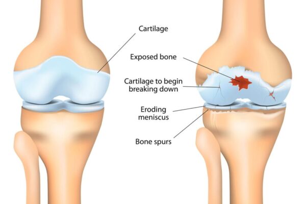 Osteoarthiritis