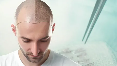 Common misconceptions about hair transplant surgery